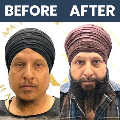 Beard Hair Transplant Result 01 - March 2025