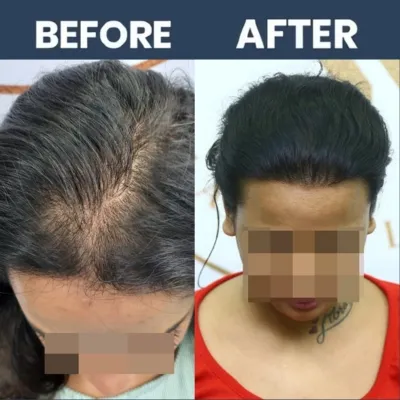 Female Hair Transplant 01 - April Result