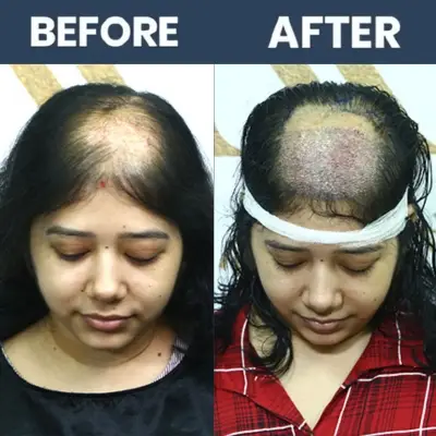 No Shave Hair Transplant Result - 01 (April 2025)