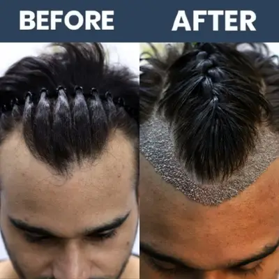 No Shave Hair Transplant Result - 02 (April 2025)