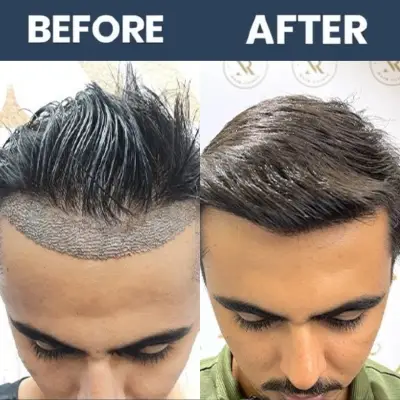 No Shave Hair Transplant Result - 04 (April 2025)